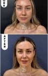 Vorher-nachher-Ergebnis der Blepharoplastik im Medical Park Antalya Hospital Complex, Lidkorrektur