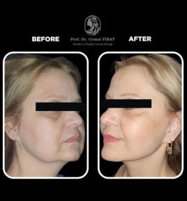 Vorher-nachher-Ergebnisse der Blepharoplastik im Medical Park Antalya Hospital Complex, Lidstraffung