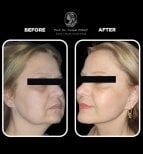 Vorher-nachher-Ergebnisse der Blepharoplastik im Medical Park Antalya Hospital Complex, Lidstraffung