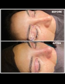 Vorher-nachher-Ergebnisse der Blepharoplastik im Medical Park Antalya Hospital Complex, Lidkorrektur