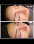 Vorher-nachher-Ergebnisse der Blepharoplastik im Medical Park Antalya Hospital Complex, Lidkorrektur