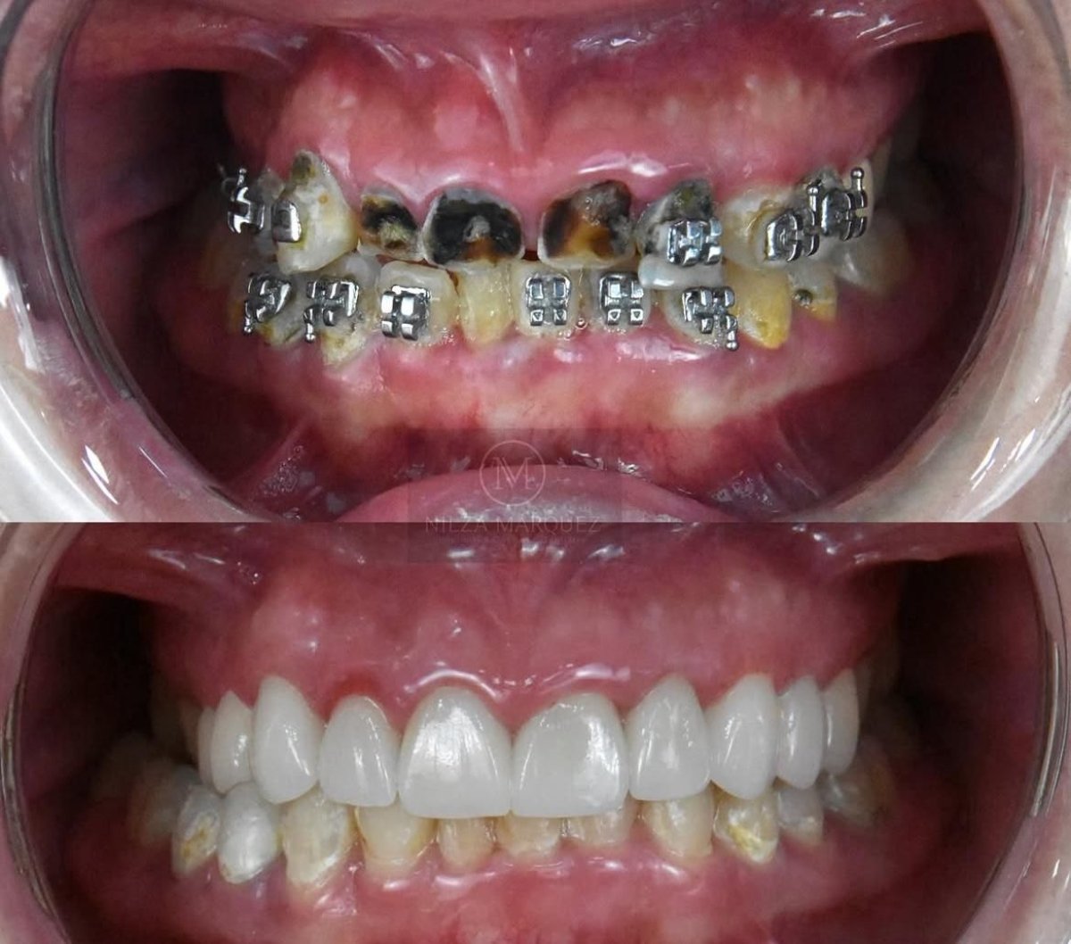 قبل وبعد تركيب تيجان الزركونيا في DDS Nilza Márquez Dental Practice، نتيجة الابتسامة