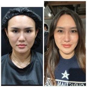 Resultados antes y después de terapia con células madre en Wansiri Hospital, rejuvenecimiento facial