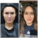 Resultados antes y después de terapia con células madre en Wansiri Hospital, rejuvenecimiento facial