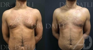 Vorher-nachher-Ergebnis der Gynäkomastie-OP in Liv Hospital Ulus, verbesserte Brustform