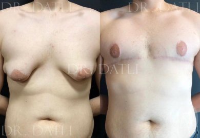 Vorher-nachher-Ergebnisse der Gynäkomastie-OP in Liv Hospital Ulus, männliche Brustkorrektur