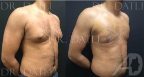 Vorher-nachher-Ergebnis Gynäkomastie-OP bei Liv Hospital Ulus, männliche Brustkontur