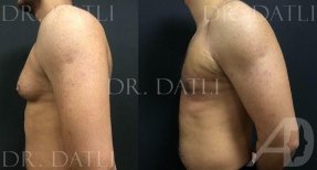 Vorher-nachher-Ergebnis Gynäkomastie-OP bei Liv Hospital Ulus – flache Männerbrust