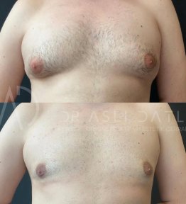 Vorher-nachher-Ergebnisse der Gynäkomastie-OP in Liv Hospital Ulus, verbesserte Brustform