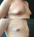 Vorher-nachher-Ergebnisse Gynäkomastie-OP bei Liv Hospital Ulus, männliche Brustkorrektur