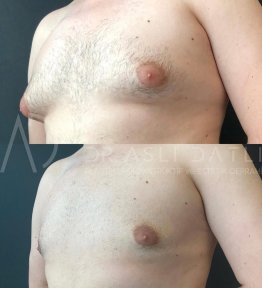 Vorher-nachher-Ergebnisse der Gynäkomastie-OP in Liv Hospital Ulus, verbesserte Brustkontur