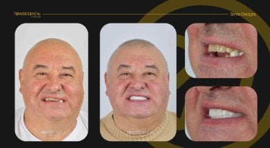 Before and after dental crown installation results at Tower Dental Clinic, improved smile aesthetics