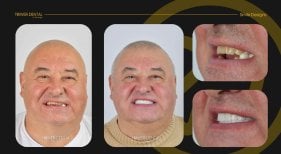 Before and after dental crown installation results at Tower Dental Clinic, improved smile aesthetics