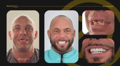 Before and after dental crown installation results at Tower Dental Clinic, smile restoration