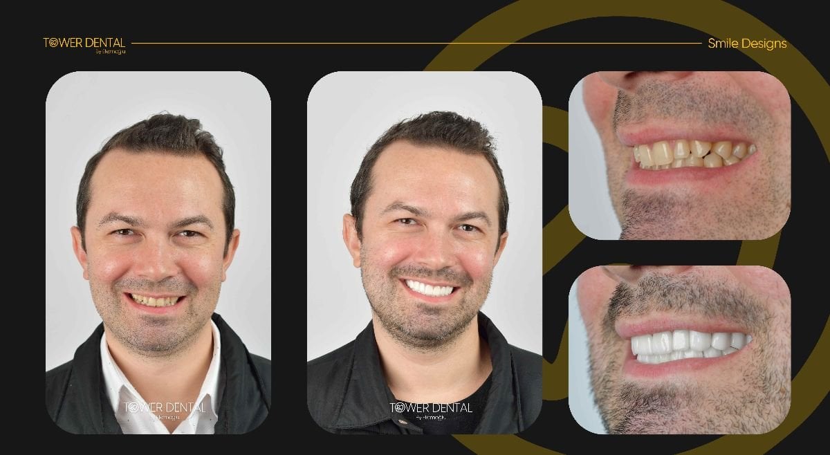 Resultados antes y después de coronas dentales en Tower Dental Clinic, mejora de la sonrisa