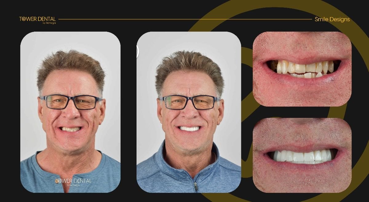Resultados antes y después de coronas dentales en Tower Dental Clinic, sonrisa mejorada