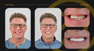 Before and after dental crown installation results at Tower Dental Clinic, improved smile aesthetics