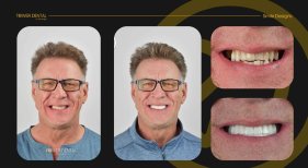 Before and after dental crown installation results at Tower Dental Clinic, improved smile aesthetics