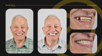 Before and after dental crown installation results at Tower Dental Clinic, improved smile design