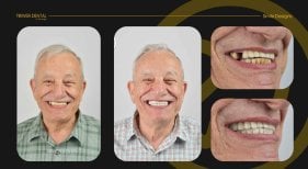 Before and after dental crown installation results at Tower Dental Clinic, improved smile design
