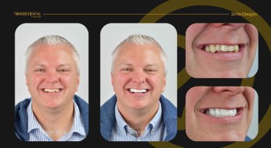 Before and after dental crown installation results at Tower Dental Clinic, improved smile aesthetics