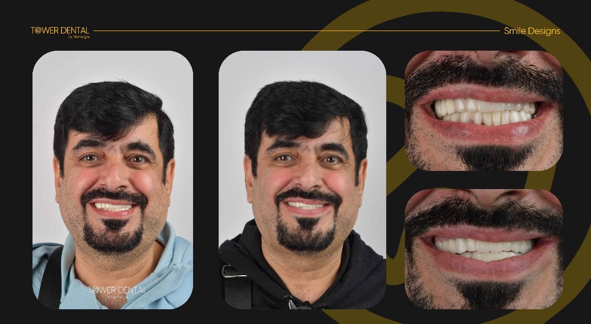نتائج قبل وبعد تركيب تيجان الأسنان في Tower Dental Clinic، تحسين تصميم الابتسامة