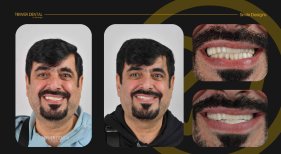 Before and after dental crown installation results at Tower Dental Clinic, improved smile design