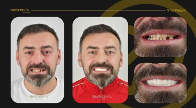 Before and after dental crown installation at Tower Dental Clinic, smile restoration result