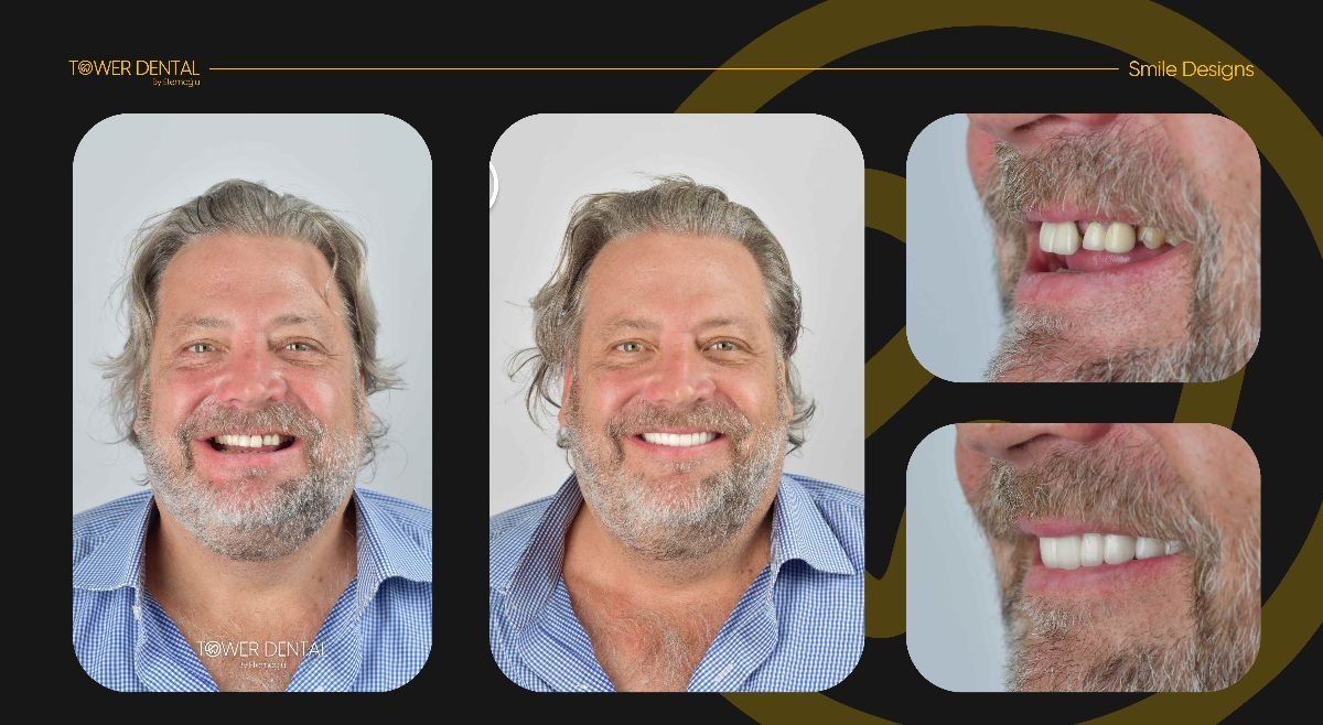 Resultados antes y después de coronas dentales en Tower Dental Clinic, sonrisa mejorada