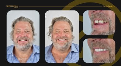 Before and after dental crown installation results at Tower Dental Clinic, improved smile aesthetics