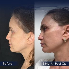 Vorher-nachher-Ergebnis Brauenlifting bei Dr. Safa Manav Clinic, 8 Monate postoperativ