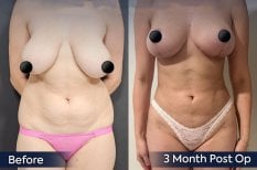 Before and after breast reduction results at Dr. Safa Manav Clinic, improved breast contour