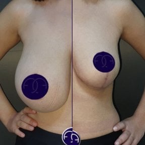 Before and after breast reduction results at Dr. Safa Manav Clinic, improved breast contour