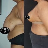 Before and after breast reduction results at Dr. Safa Manav Clinic, improved breast contour
