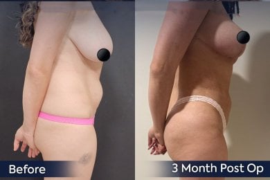 Breast reduction before and after results at Dr. Safa Manav Clinic, improved contour visible