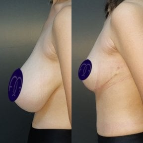 Before and after breast reduction results at Dr. Safa Manav Clinic, improved breast contour