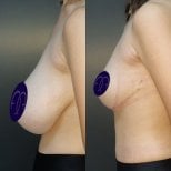 Before and after breast reduction results at Dr. Safa Manav Clinic, improved breast contour