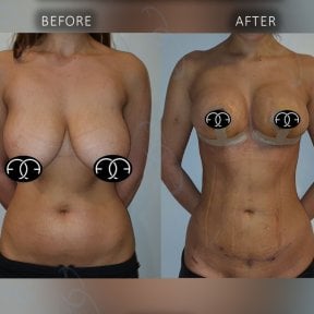 Before and after breast reduction results at Dr. Safa Manav Clinic, improved breast contour