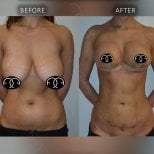 Before and after breast reduction results at Dr. Safa Manav Clinic, improved breast contour