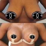 Before and after breast reduction results at Dr. Safa Manav Clinic, improved breast contour