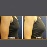 Before and after breast augmentation with fat transfer results at ID Clinic Bangkok