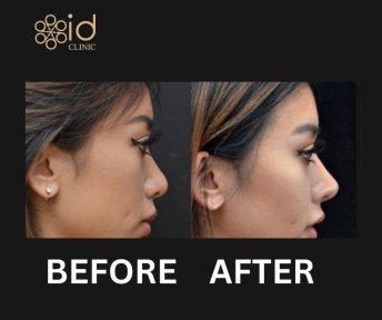 Before and after rhinoplasty results at ID Clinic Bangkok, nose reshaping for improved profile