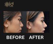Before and after rhinoplasty results at ID Clinic Bangkok, nose reshaping for improved profile