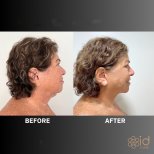 Deep plane facelift before and after results at ID Clinic Bangkok, visible facial rejuvenation