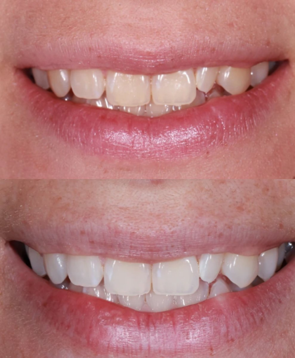 Vorher-nachher-Ergebnis Zahnreinigung (Scaling) bei Atelier Uśmiechu, sichtbar weißeres Lächeln
