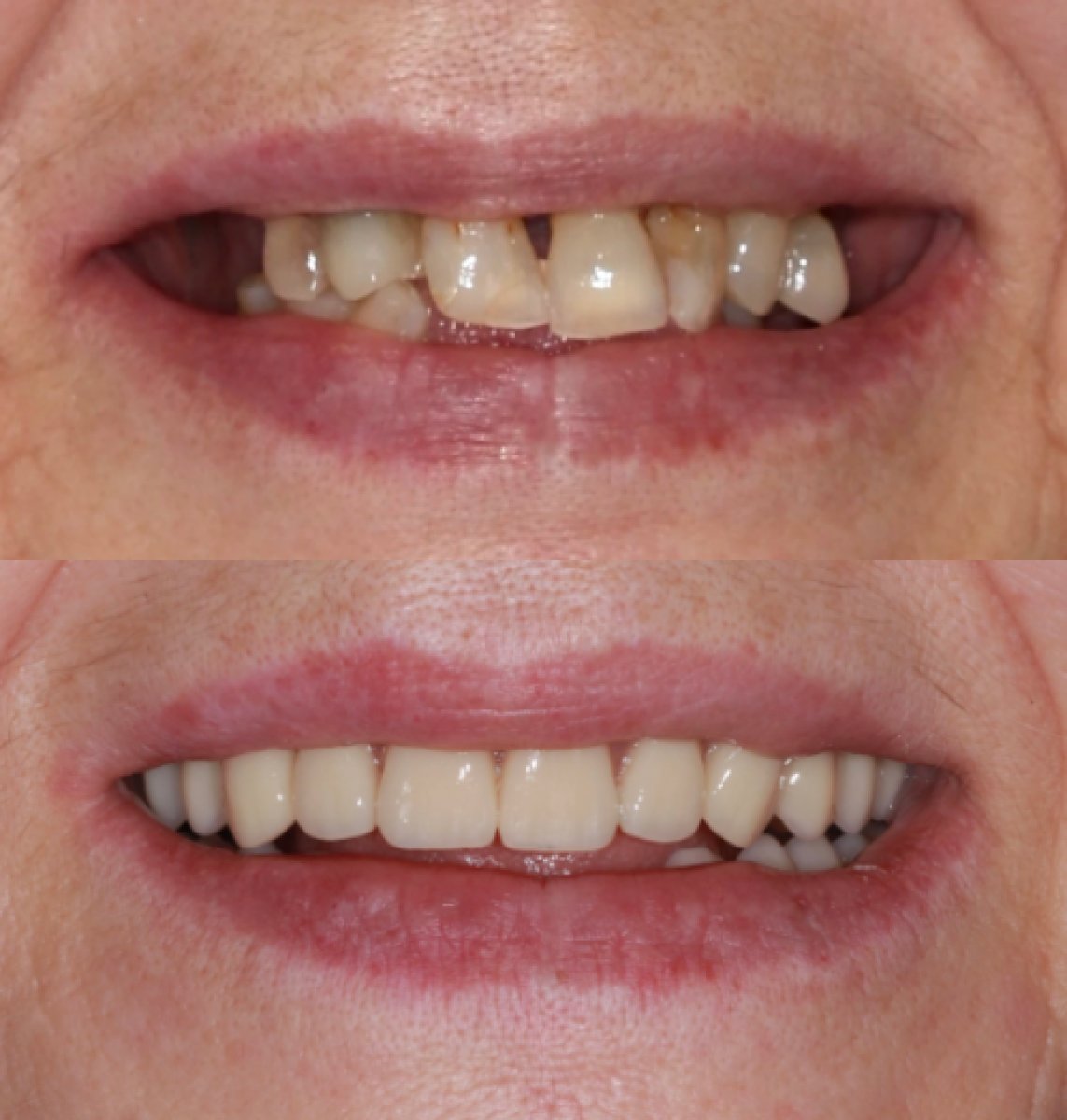Vorher-nachher All-on-4 Zahnimplantate bei Atelier Uśmiechu, Ergebnis der Lächelrestauration