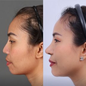 Facial feminization surgery before and after results at Dr. Chen Surgery Hospital International Center