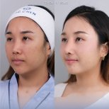 Facial feminization surgery before and after result at Dr. Chen Surgery Hospital International Center