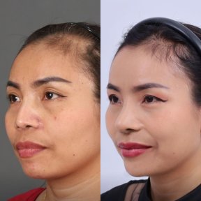 Facial feminization surgery before and after results at Dr. Chen Surgery Hospital International Center