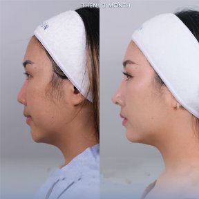 Facial feminization surgery before and after result at Dr. Chen Surgery Hospital International Center